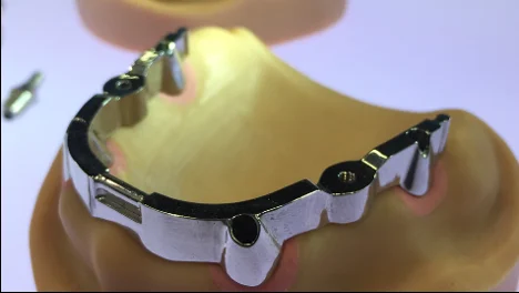 Milled titanium implant bar on a model